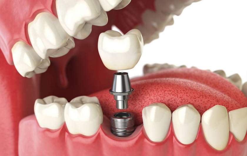 Ce este procedura de implant dentar?